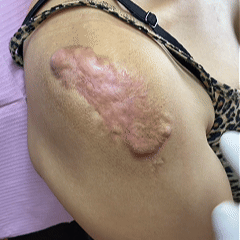 Trilumia silicone scar therapy roll