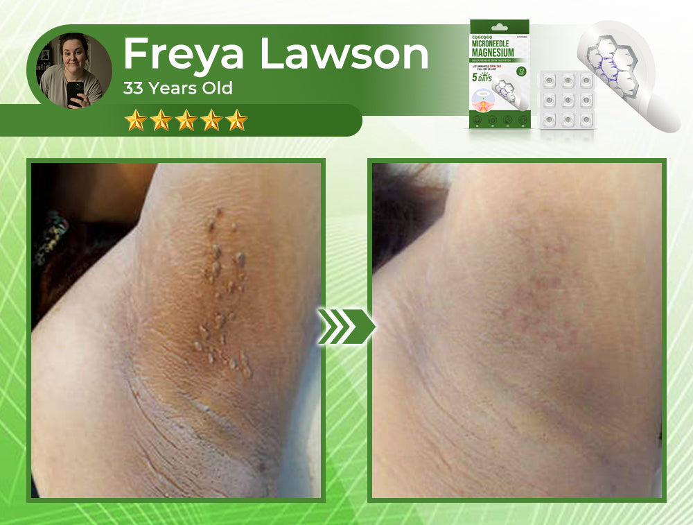💗Final 3 Hours: 80% OFF - CQGCQGQ® Magnesium MicroNeedle Quick Remove Skin Tag Patches