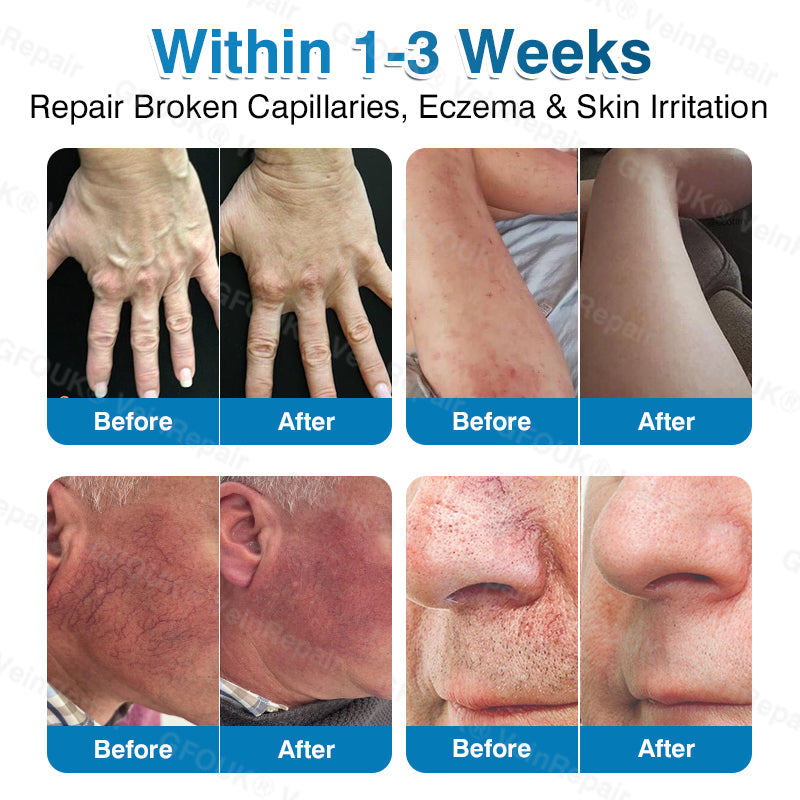 🇺🇸🏅🛡️GFOUK® VeinRepair Microneedle Patch Roll⚡Instant Relief, Long-Term Results