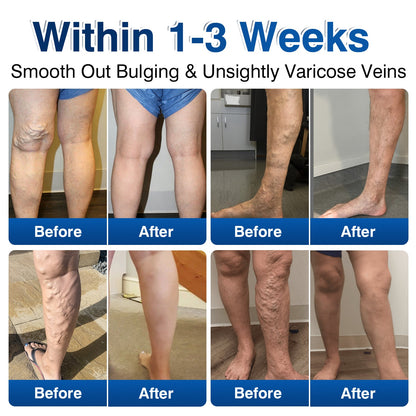 🇺🇸👨‍⚕️🦵🛡️GFOUK® VeinRenew Microneedle Balm