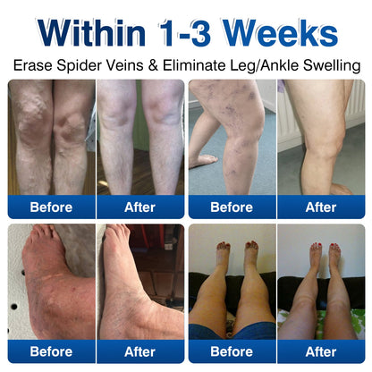 🇺🇸👨‍⚕️🦵🛡️GFOUK® VeinRenew Microneedle Balm