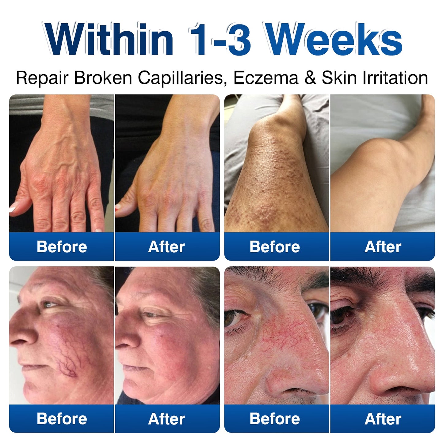 🇺🇸👨‍⚕️🦵🛡️GFOUK® VeinRenew Microneedle Balm
