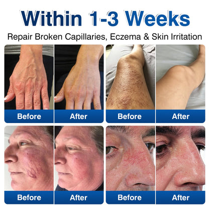 🇺🇸👨‍⚕️🦵🛡️GFOUK® VeinRenew Microneedle Balm