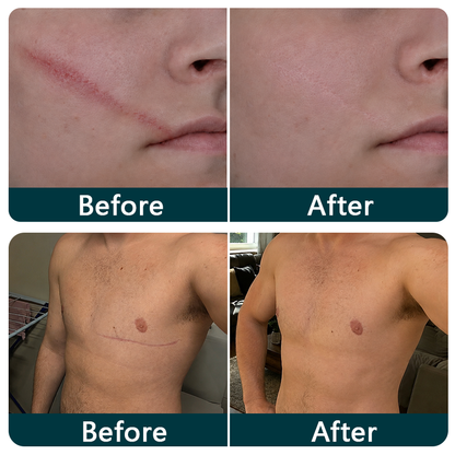👩‍⚕️Trilumia® Silicone Scar Therapy Roll — Custom-Fit Care for Long, Raised Surgical Scars