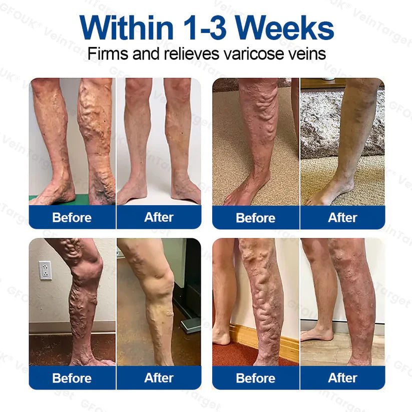 💧✅GFOUK® VeinTarget Microneedle Patch⚡Instant Relief, Long-Term Results