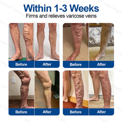 💧✅GFOUK® VeinTarget Microneedle Patch⚡Instant Relief, Long-Term Results