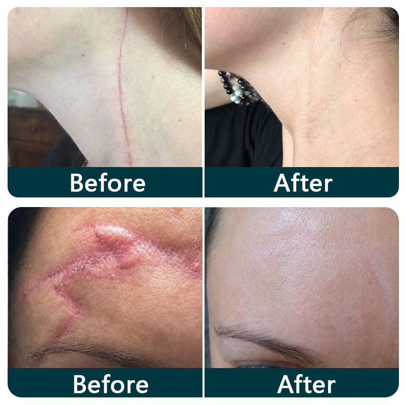 👩‍⚕️Trilumia® Silicone Scar Therapy Roll — Custom-Fit Care for Long, Raised Surgical Scars
