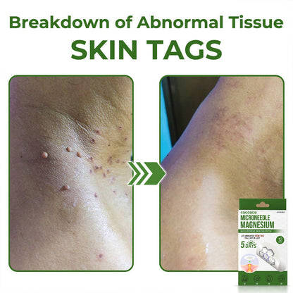 💗Final 3 Hours: 80% OFF - CQGCQGQ® Magnesium MicroNeedle Quick Remove Skin Tag Patches