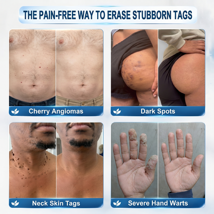 Official Store🚁𝐏i𝐜𝐝o® 7-𝐷𝑎𝑦 𝗧𝐚𝐠 & 𝗦𝗽𝐨𝐭 𝐄𝐫𝒂𝒔𝒆𝒓(Zero Pain, Zero 𝐒𝐜𝐚𝒓𝒔 Rollerball)