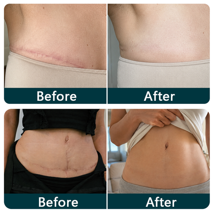 👩‍⚕️Trilumia® Silicone Scar Therapy Roll — Custom-Fit Care for Long, Raised Surgical Scars