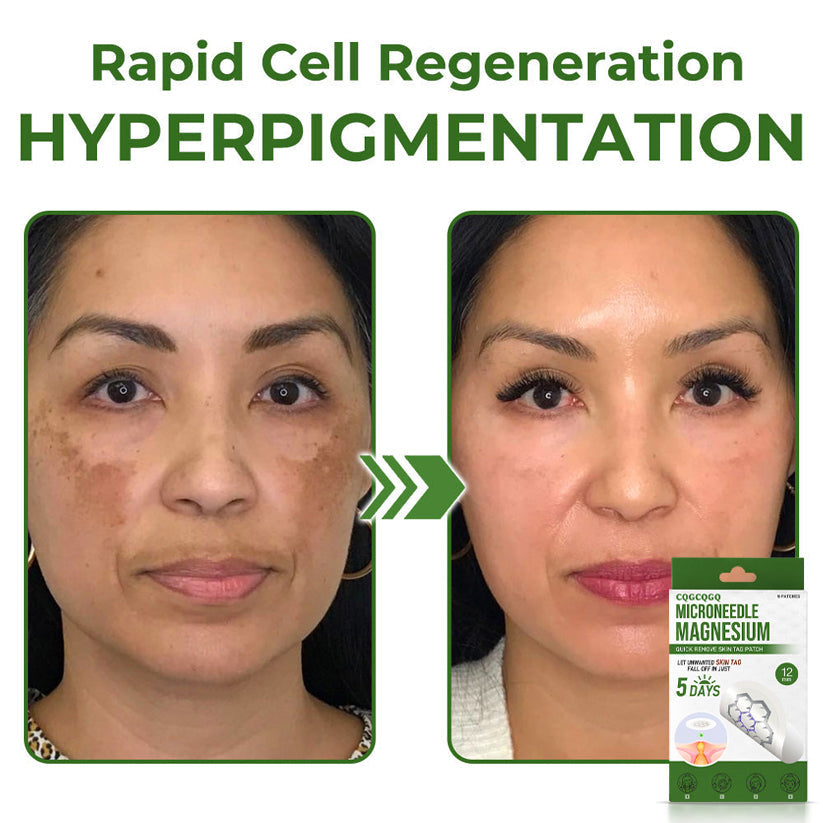 💗Final 3 Hours: 80% OFF - CQGCQGQ® Magnesium MicroNeedle Quick Remove Skin Tag Patches