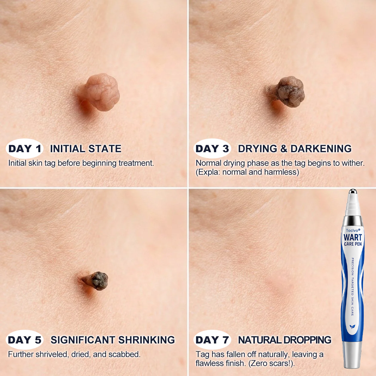 🫆 Toclvo® Fast-Acting Wart Remover Care Pen | Targets Warts, Skin Tags & Rough Bumps
