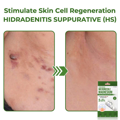💗Final 3 Hours: 80% OFF - CQGCQGQ® Magnesium MicroNeedle Quick Remove Skin Tag Patches