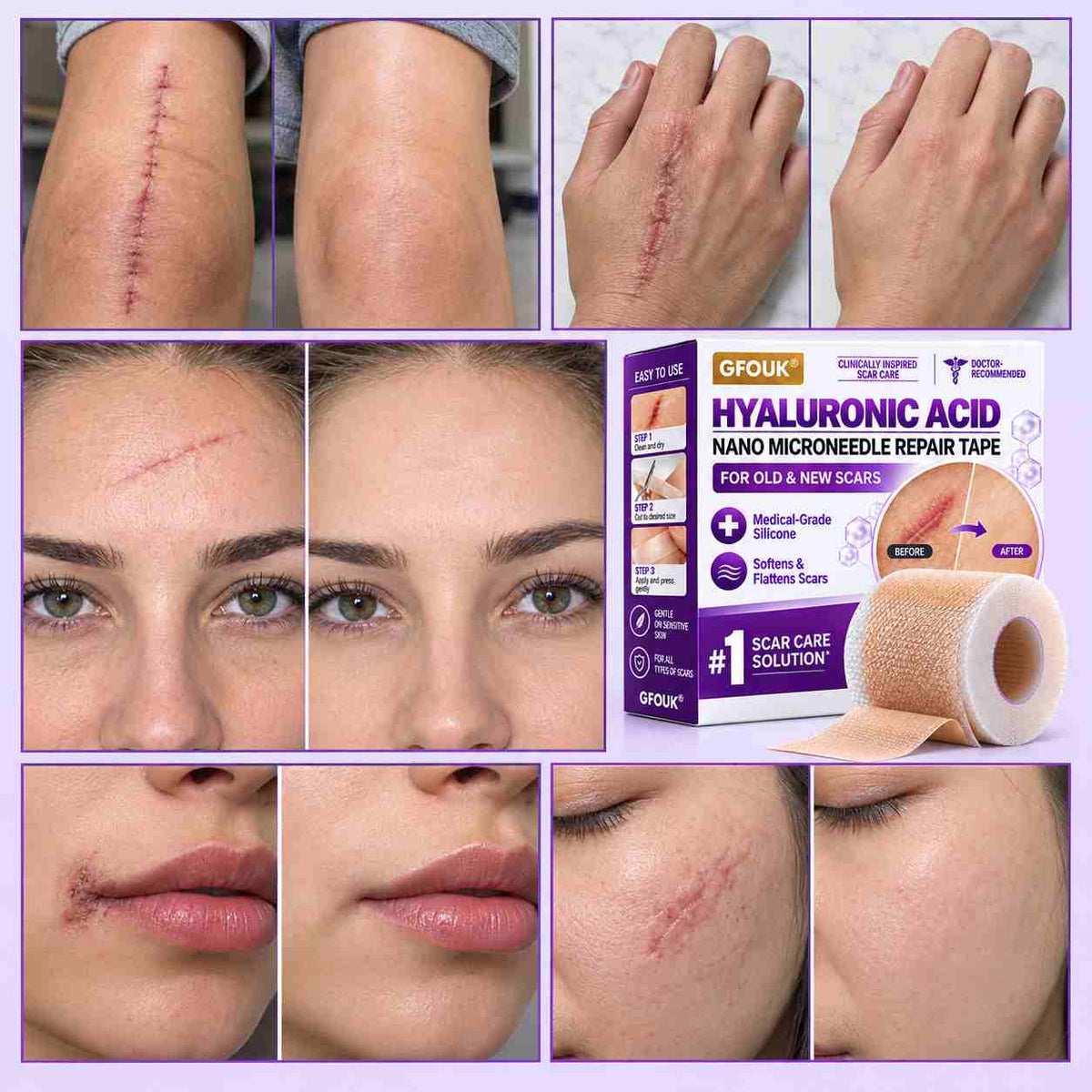 ✅GFOUK® Hyaluronic Acid Nano Microneedle Repair Tape🗽🍃