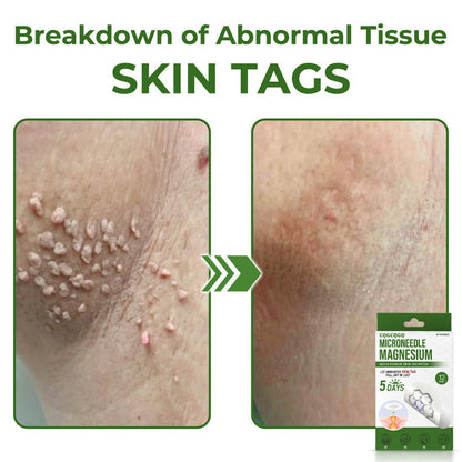 💗Final 3 Hours: 80% OFF - CQGCQGQ® Magnesium MicroNeedle Quick Remove Skin Tag Patches