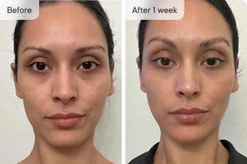 🔥Final 3 hours-60%OFF &Smooth, firm and plump stubborn areas with Micro-Infusion Targeted Patches