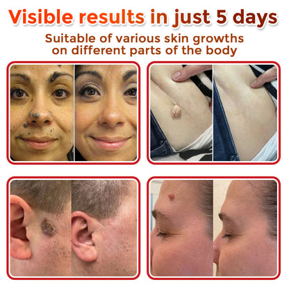 🔥🎇GFOUK® MicroNeedle Botanic Skin Tag Removal Patch 🇺🇸 Made in the USA