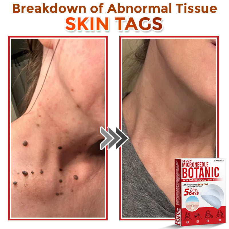 🔥🎇GFOUK® MicroNeedle Botanic Skin Tag Removal Patch 🇺🇸 Made in the USA