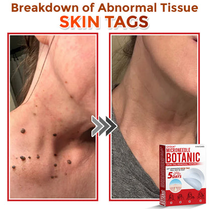 🔥🎇GFOUK® MicroNeedle Botanic Skin Tag Removal Patch 🇺🇸 Made in the USA