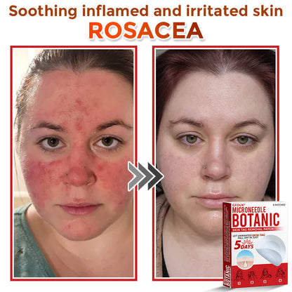 🔥🎇GFOUK® MicroNeedle Botanic Skin Tag Removal Patch 🇺🇸 Made in the USA