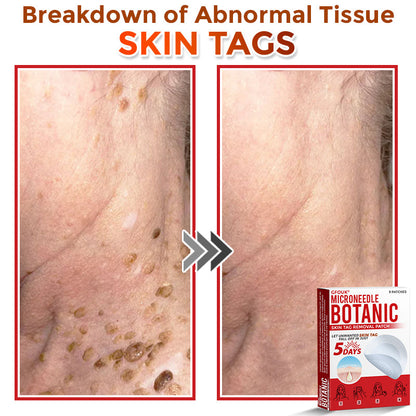🔥🎇GFOUK® MicroNeedle Botanic Skin Tag Removal Patch 🇺🇸 Made in the USA