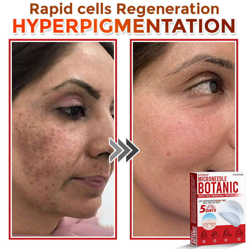 🔥🎇GFOUK® MicroNeedle Botanic Skin Tag Removal Patch 🇺🇸 Made in the USA
