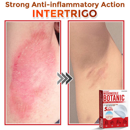 🔥🎇GFOUK® MicroNeedle Botanic Skin Tag Removal Patch 🇺🇸 Made in the USA