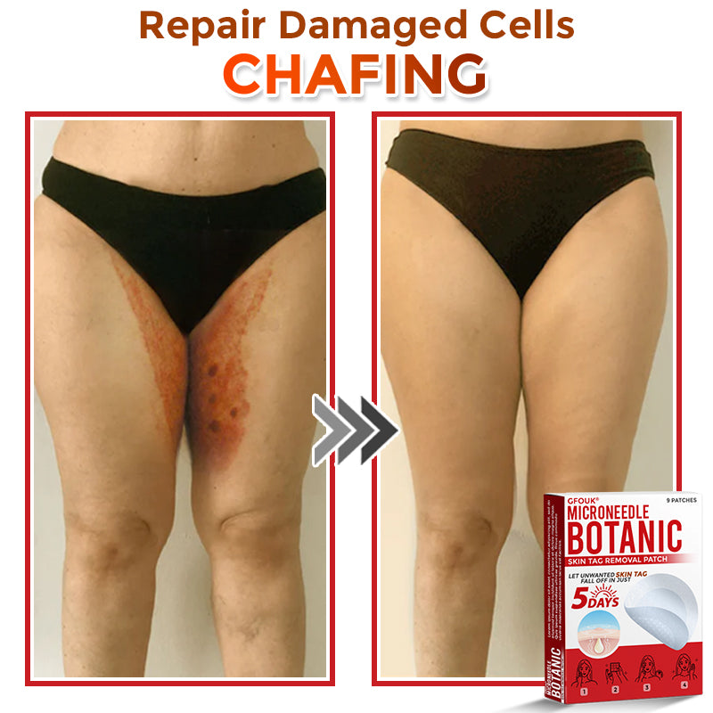 🔥🎇GFOUK® MicroNeedle Botanic Skin Tag Removal Patch 🇺🇸 Made in the USA