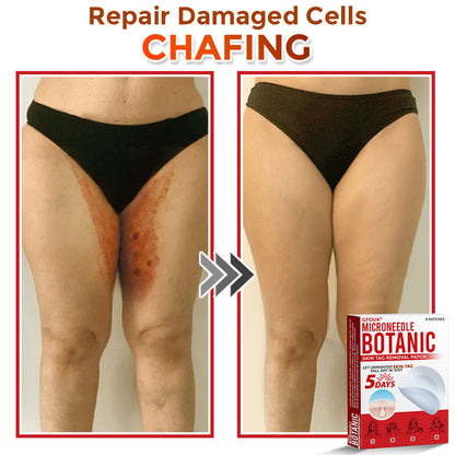 🔥🎇GFOUK® MicroNeedle Botanic Skin Tag Removal Patch 🇺🇸 Made in the USA