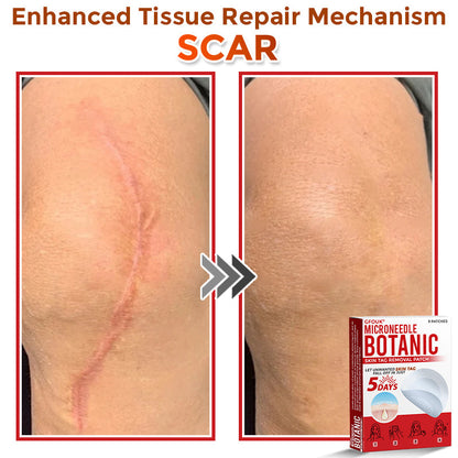 🔥🎇GFOUK® MicroNeedle Botanic Skin Tag Removal Patch 🇺🇸 Made in the USA