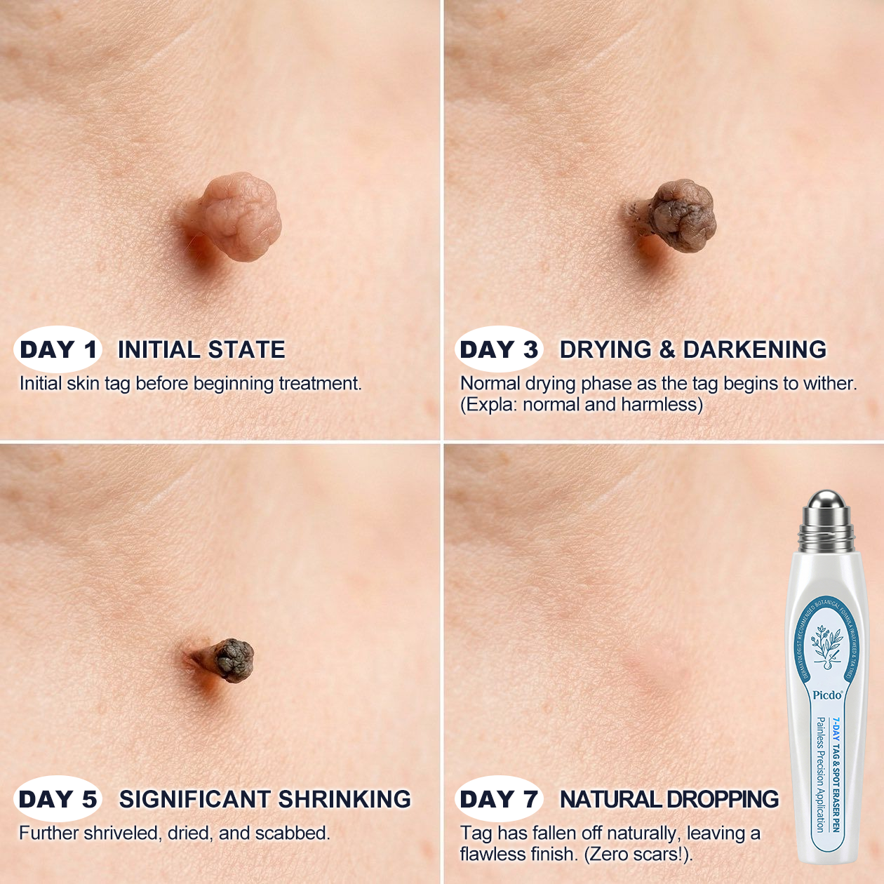 Official Store🚁𝐏i𝐜𝐝o® 7-𝐷𝑎𝑦 𝗧𝐚𝐠 & 𝗦𝗽𝐨𝐭 𝐄𝐫𝒂𝒔𝒆𝒓(Zero Pain, Zero 𝐒𝐜𝐚𝒓𝒔 Rollerball)