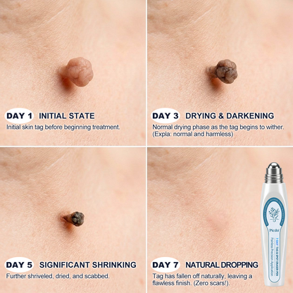 Official Store🚁𝐏i𝐜𝐝o® 7-𝐷𝑎𝑦 𝗧𝐚𝐠 & 𝗦𝗽𝐨𝐭 𝐄𝐫𝒂𝒔𝒆𝒓(Zero Pain, Zero 𝐒𝐜𝐚𝒓𝒔 Rollerball)